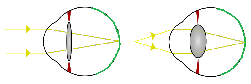 Schéma montrant le changement de forme du cristallin et son effet sur la focalisation.